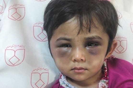 کودک آزار دیده با صورت کبود+عکس