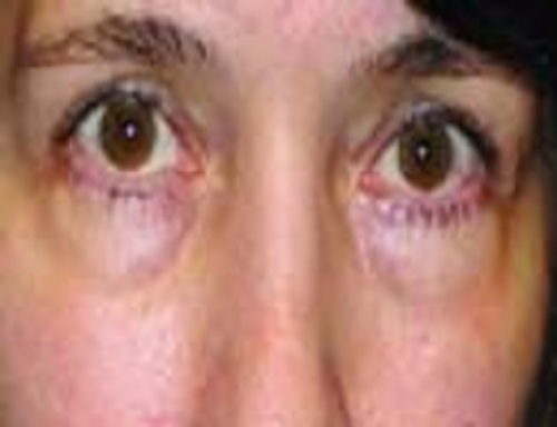 روش های درمان پف و سیاهی زیر چشم