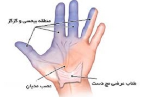 علت ایجاد گزگز دست و روش‌های درمان آن