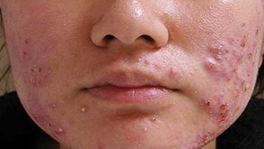 روش‌های ساده و خانگی برای کاهش و رفع آکنه پوست صورت