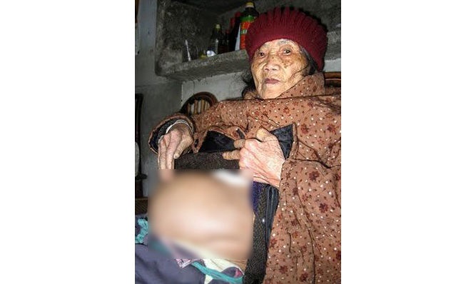 پیرزن ۹۲ ساله جنین سنگی زایمان کرد! + عکس