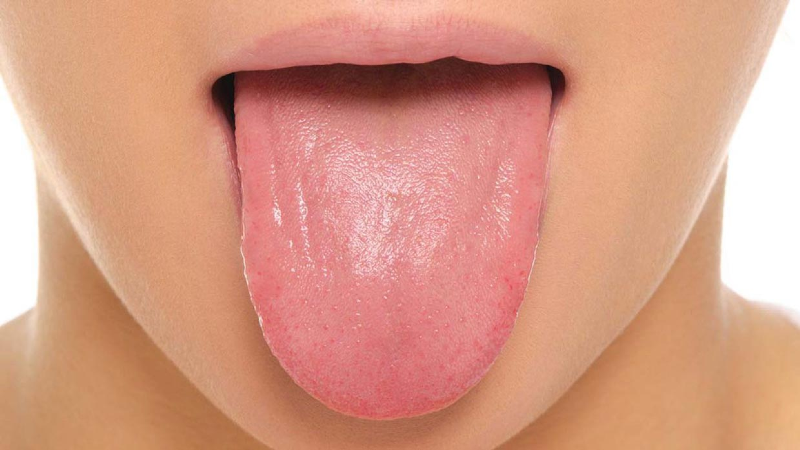 چه چیزی موجب بروز لکه های سفید و گرد روی زبان می شود؟