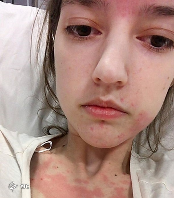 دختری با بیماری عجیب که غذا را از طریق قلبش می‌خورد + تصاویر